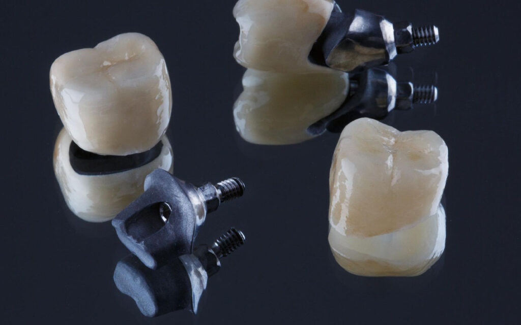 Dental Implants in Renton, WA | Cedar Dental Group
