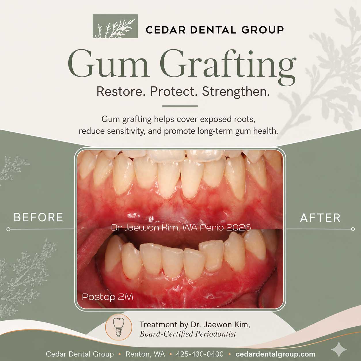 gum grafting renton wa