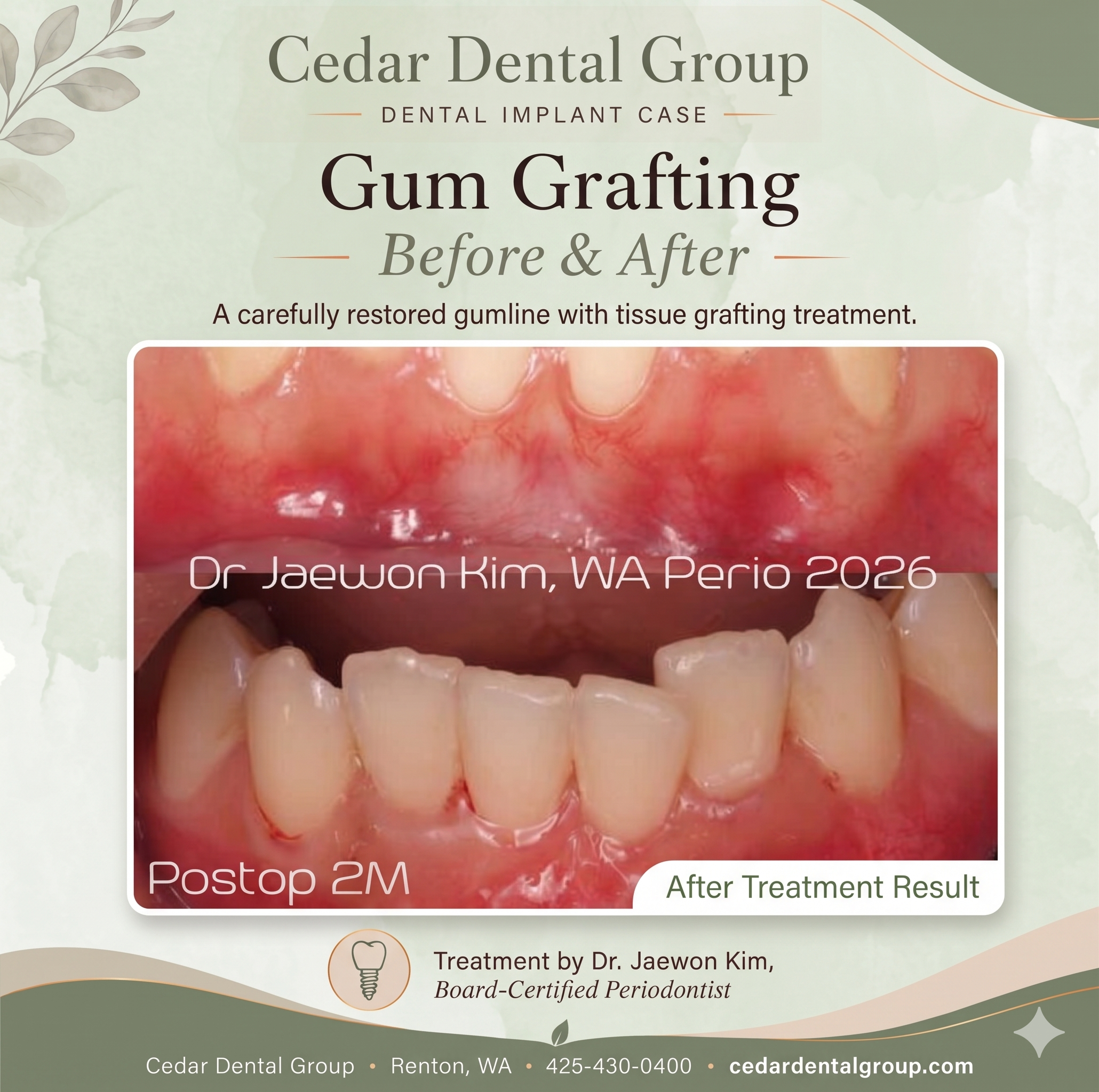gum grafting renton wa