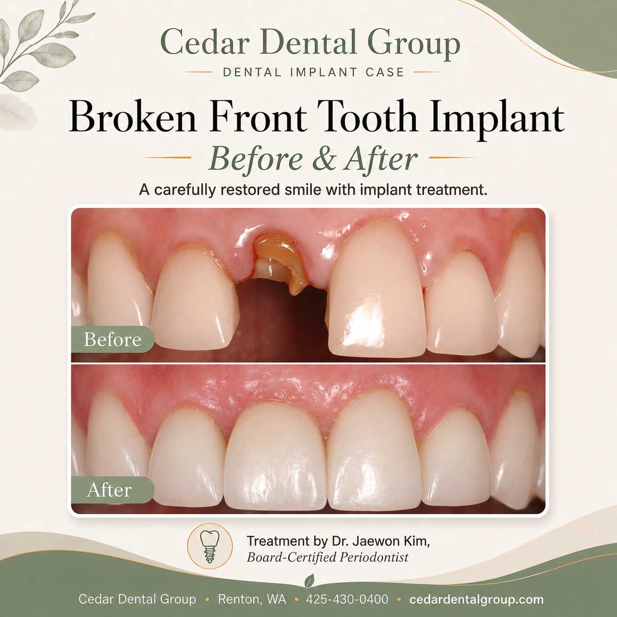 dental implant before and after renton wa