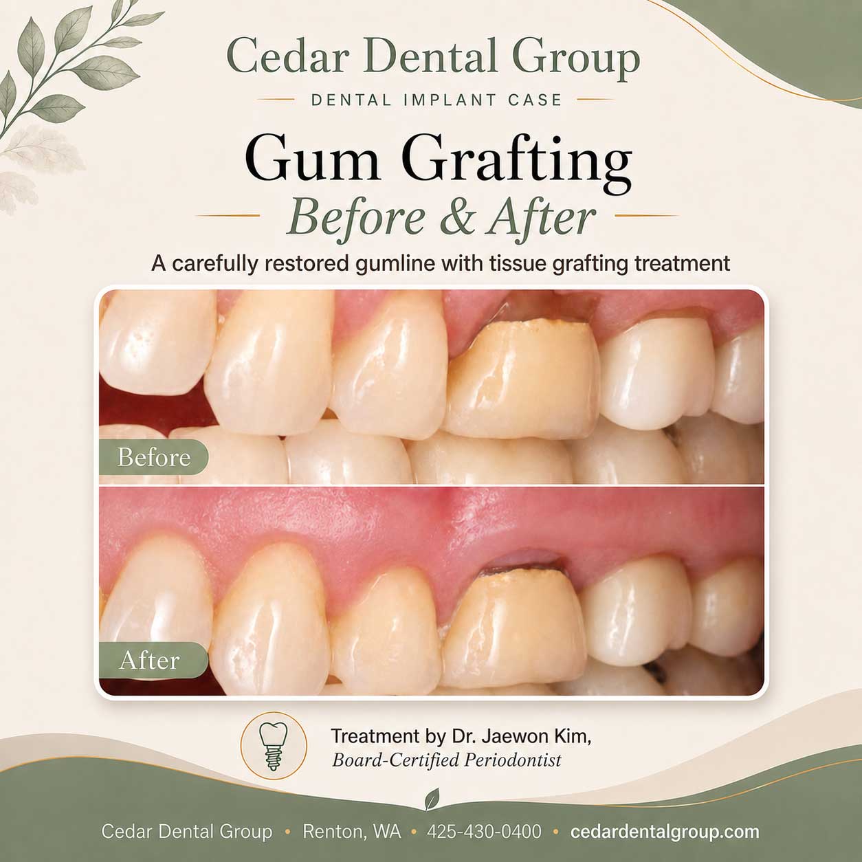 gum grafting renton wa