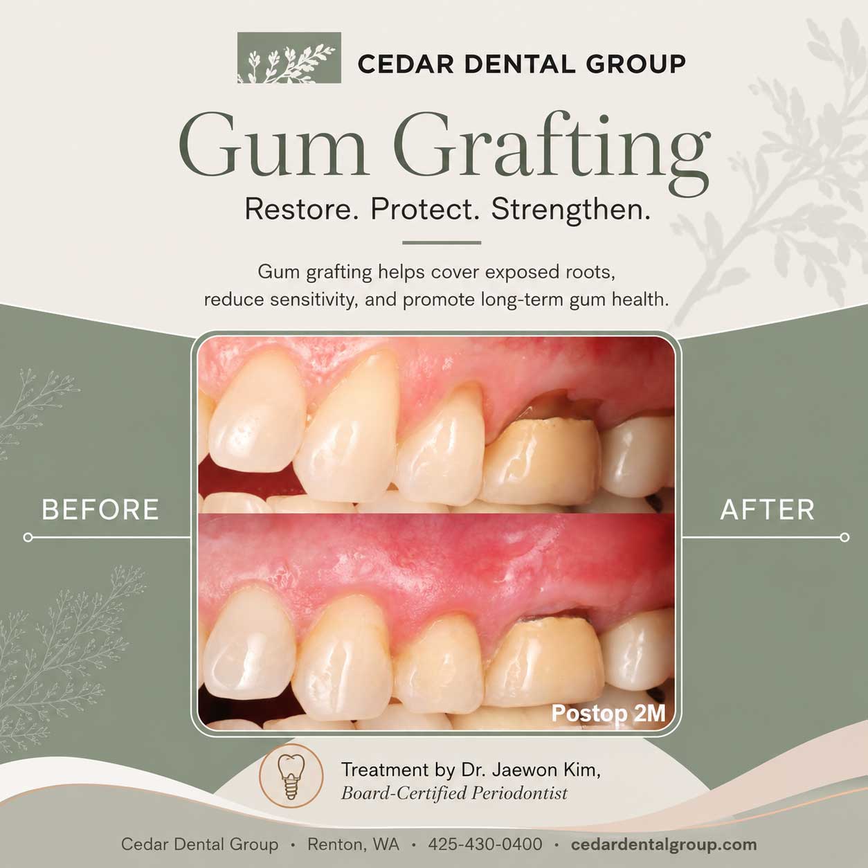 renton wa gum grafting