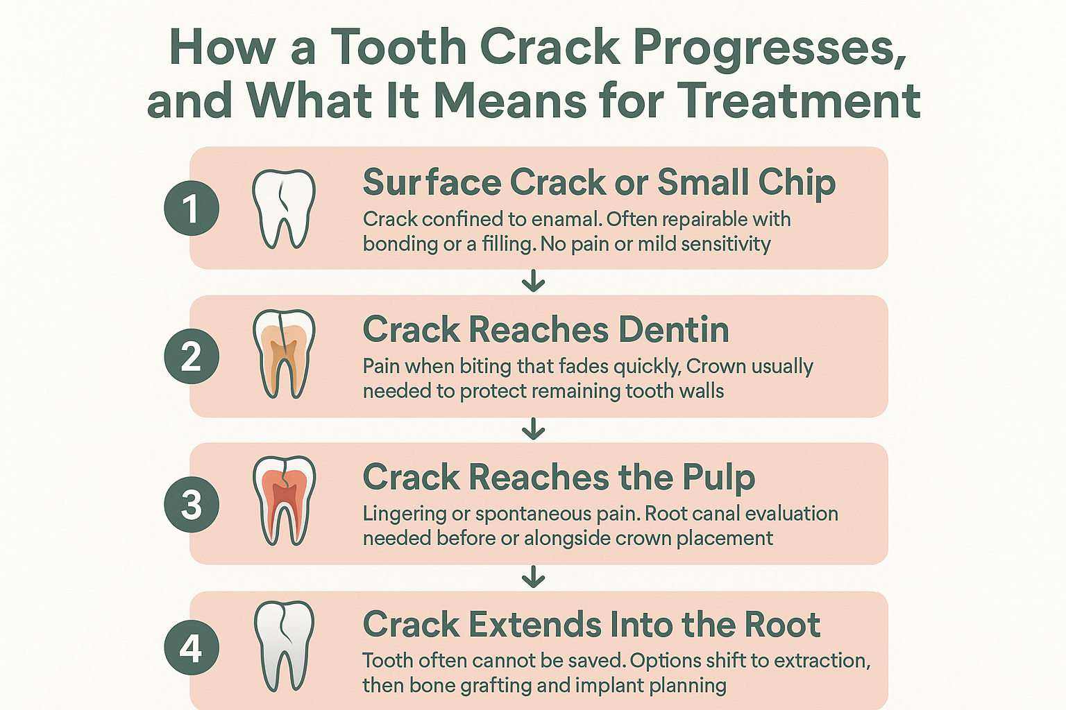 Infographic showing four stages of tooth crack progression from surface chip to root crack, with treatment implications at each stage