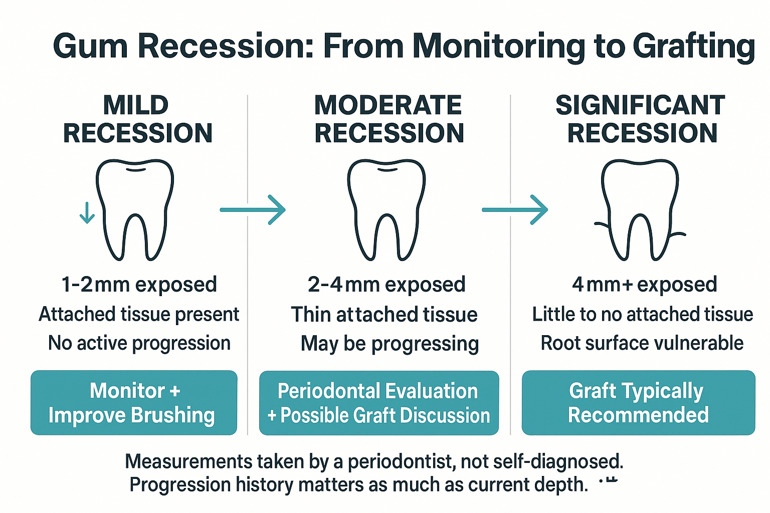 Receding Gums: How to Tell If a Graft Is Actually Necessary